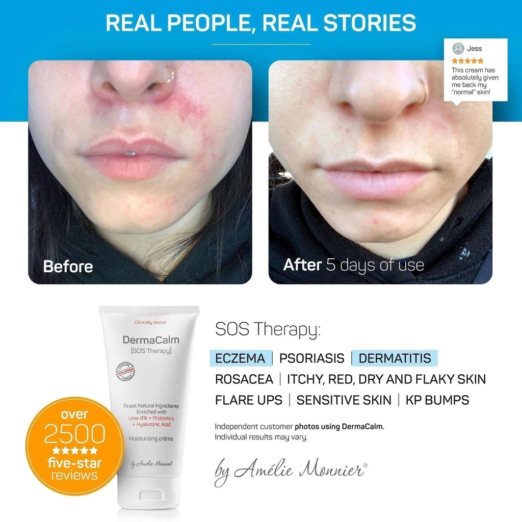 clinically-tested-dermacalm-sos-therapy--4.jpg