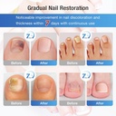 fungal-nail-patches-60-pcs-upgraded-toe--5.jpg