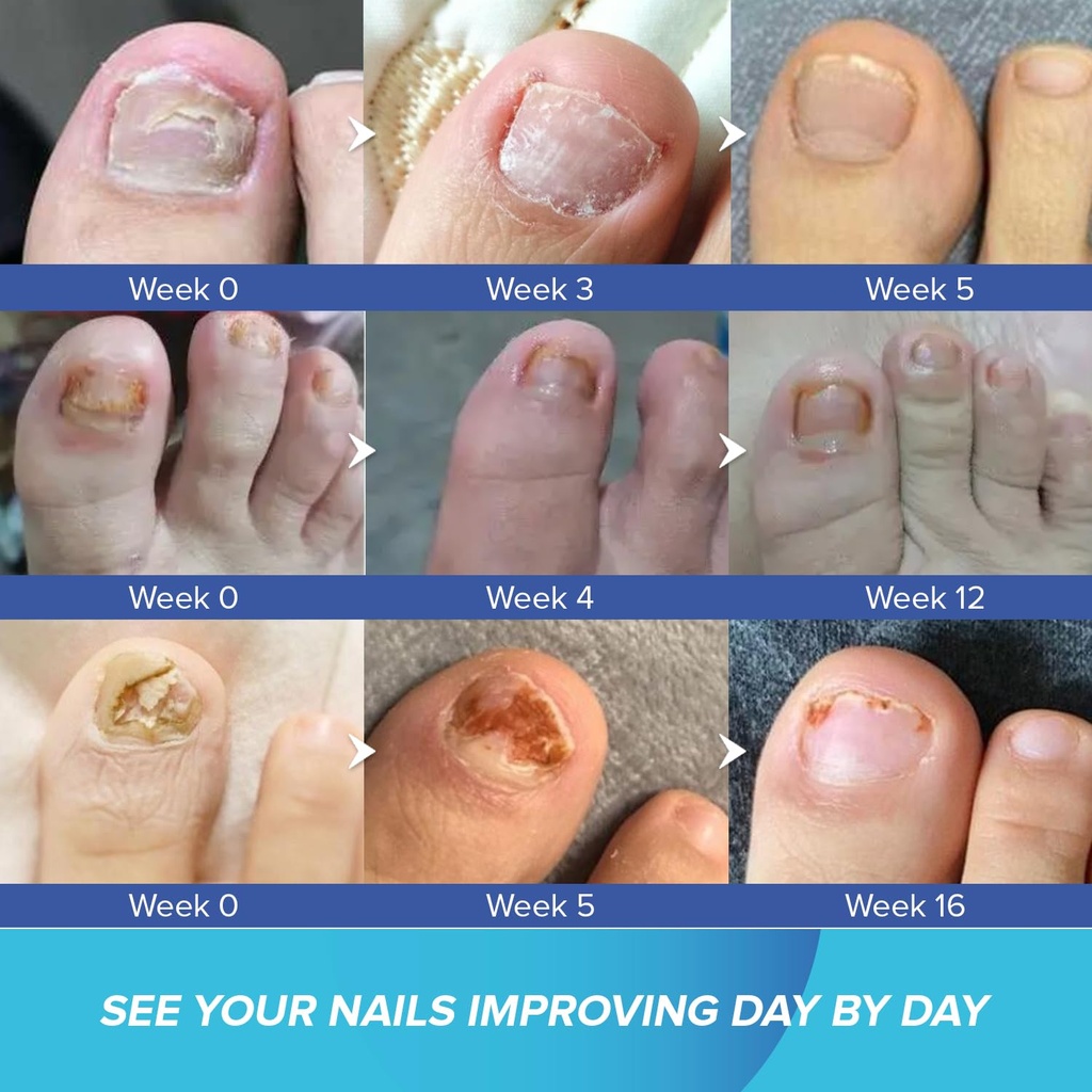 toenail-fungus-treatment-extra-strength--2.jpg